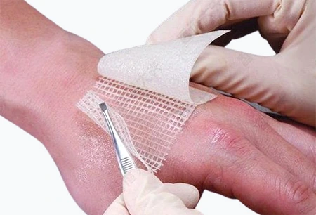 Medicated Paraffin Gauze Dressing